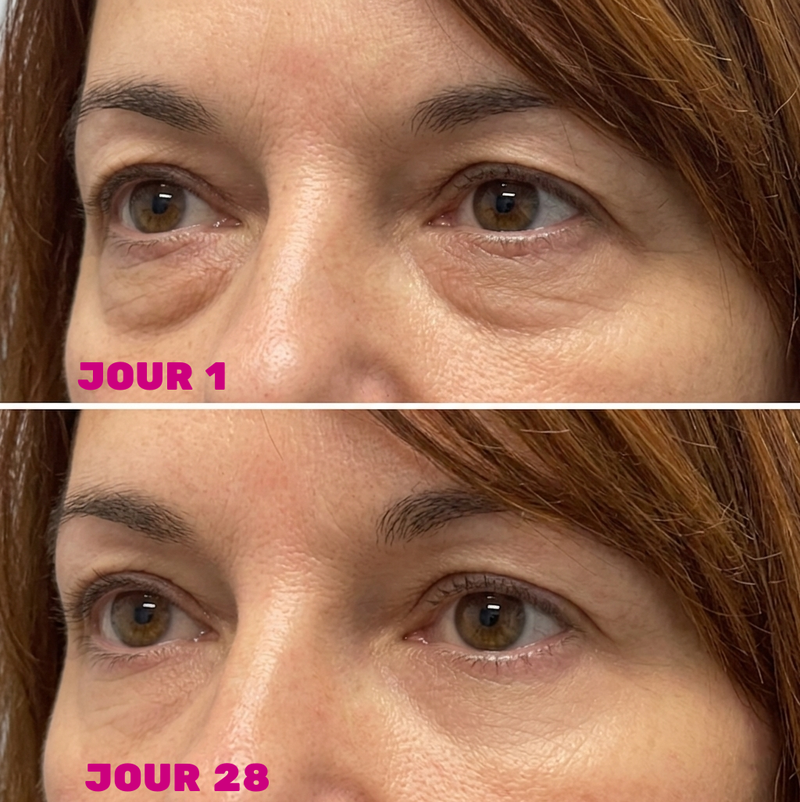 J'ai 32 ans et mes paupières tombaient déjà
